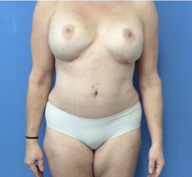 Tummy-Tuck-with-Liposuction--Case-Study-8642 | After Liposuction
